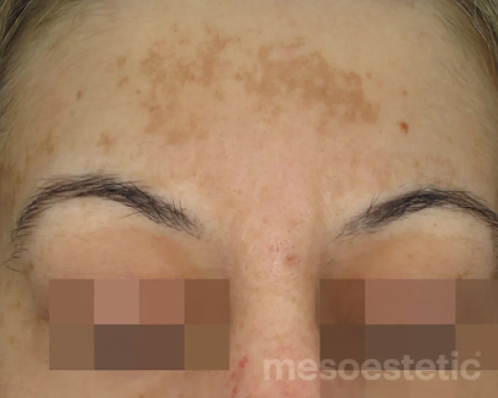 Cosmelan