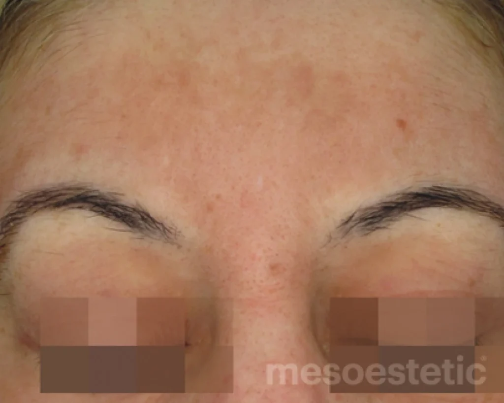 Cosmelan
